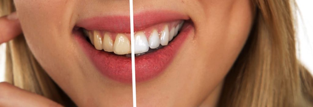 dientes blancos y dientes amarillos