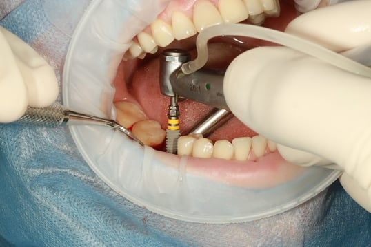 cirugía de implante de diente