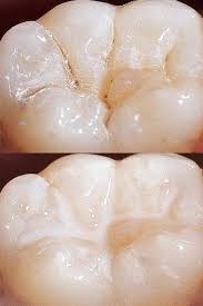 sellante dental